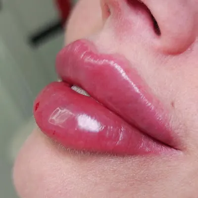 Zastrzyk Piękna | Kosmetolog Anna Gajęcka